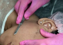 Dermaplaning 11 derma m9 - Experimente o Dermaplaning para uma pele incrivelmente suave e radiante. Remova suavemente as células mortas e os pelos faciais, revelando uma aparência rejuvenescida. Descubra o segredo da beleza da pele agora!