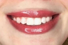 Combo Magic Lips 3 em 1 5 ml3 - Descubra a magia do nosso Combo Magic Lips 3 em 1. Transforme seus lábios com estilo e praticidade. Experimente agora para um sorriso deslumbrante!